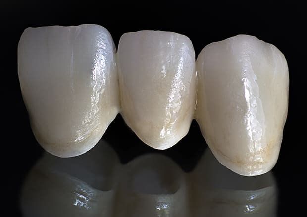 ブリッジの生存率について