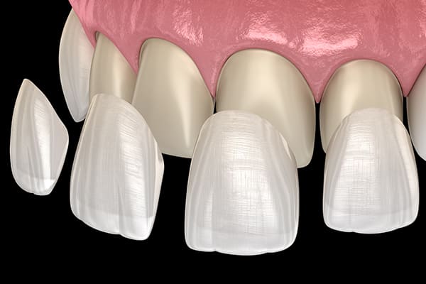 ラミネートべニア