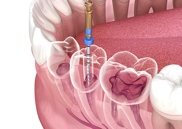 根管治療とは？